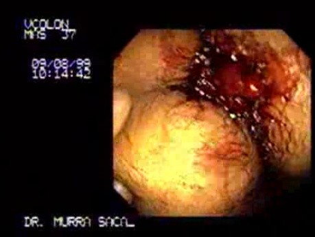 Stalk Villous Adenoma (2 of 2)