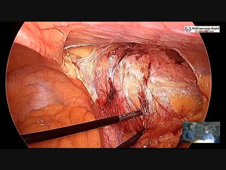 Easiest Way of Performing Laparoscopic Inguinal Hernia Repair Using Less Expensive Mesh