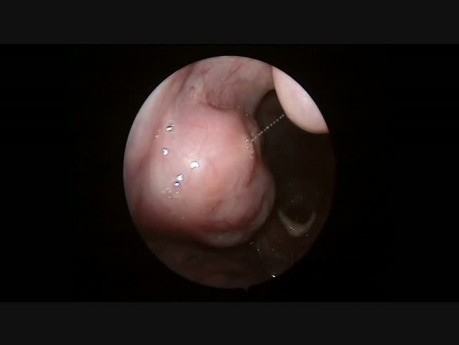 Diagnostic Endoscopy of Oropharynx, Hypopharynx & Larynx