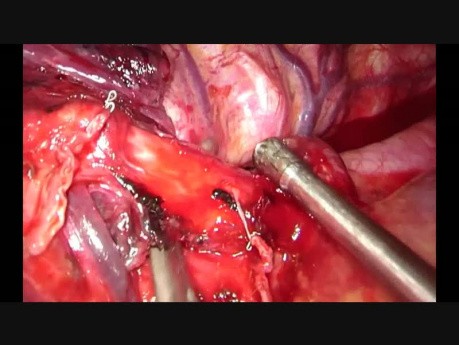 Useful Tricks to Divide the Upper Lobe Bronchus through Uniportal VATS