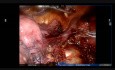 Aberrant Vessel During Robotic Left Upper Lobe Apical and Posterior Segmentectomy