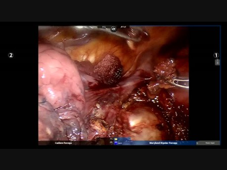 Aberrant Vessel During Robotic Left Upper Lobe Apical and Posterior Segmentectomy