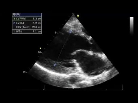 An Echocardiography Quiz: What Is the Severity of Aortic Regurgitation?