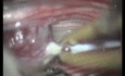 Filum Terminale Ependymoma - Posterior Approach