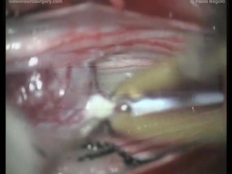 Filum Terminale Ependymoma - Posterior Approach