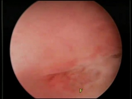 Excessive Proliferation of the Cells of the Endometrium - Endometrial Hyperplasia