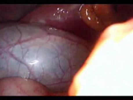 Colonic Perforation With Peritonitis - Laparoscopy (41 of 46)