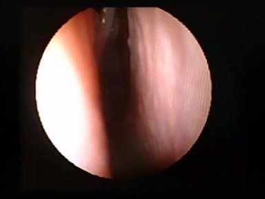 Normal Nasal Turbinates