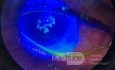 Herpes Zoster Ophthalmicus