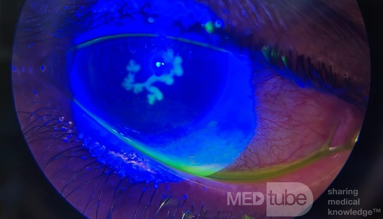 Herpes Zoster Ophthalmicus