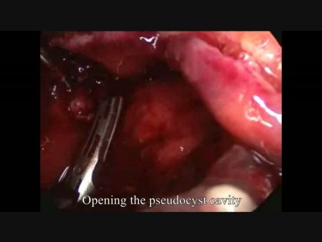 Laparoscopic Surgery for Infected Pancreatic Pseudocyst