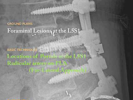 BESS L5S1 Lesion