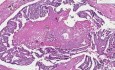 Ductal carcinoma in situ - Histopathology - Breast