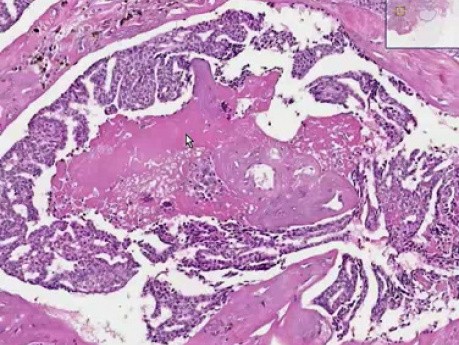 Ductal carcinoma in situ - Histopathology - Breast