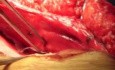 Intestinal resection in incisional hernia