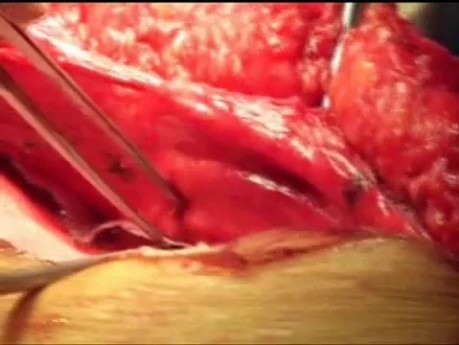 Intestinal resection in incisional hernia