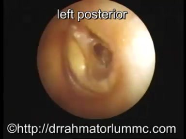 Pars Tensa Eardrum Perforation - Posterior vs. Central 