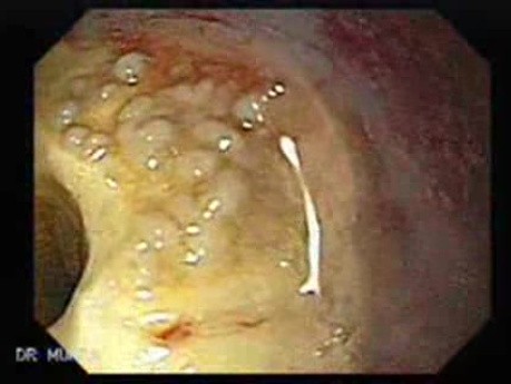 Gastric Cicatrization With Pylorus Stenosis (2 of 23)