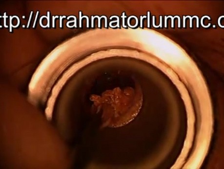 Earwax Suctioning