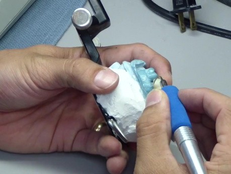 Lab Processed Bridge Fabrication - Radica - Repair Marginal Discrepancies