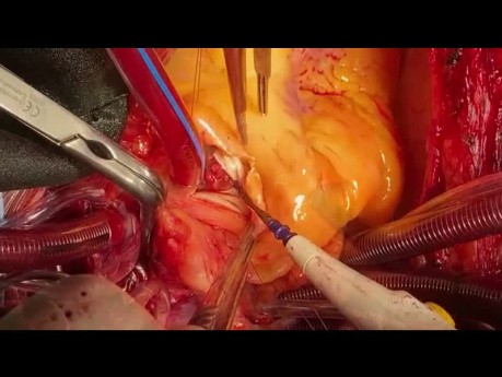 Patient with Double Valve Endocarditis and Fistula Between Two Trunc 