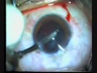 Phacoemulsification