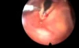 Laryngoscopy with Biopsy of Vocal Cord