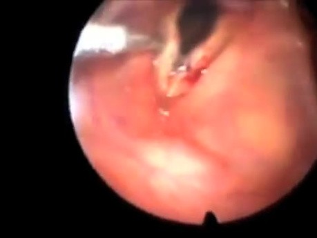 Laryngoscopy with Biopsy of Vocal Cord