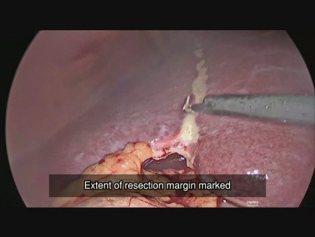 Laparoscopic Right Liver Resection