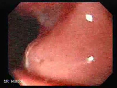 Gastric Lymphoma - Presence of Irregular Ulcers