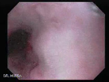 Palliation of Dysphagia of Esophageal Cancer - Endoscopic Lumen Restoration