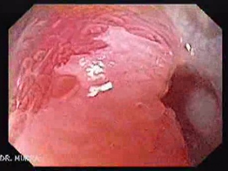 Longstanding gastroesophageal reflux disease -short segments of Barrett's esophagus (5 of 7)