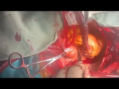 Patient with DCMP and LV Clot and Normal CAG 