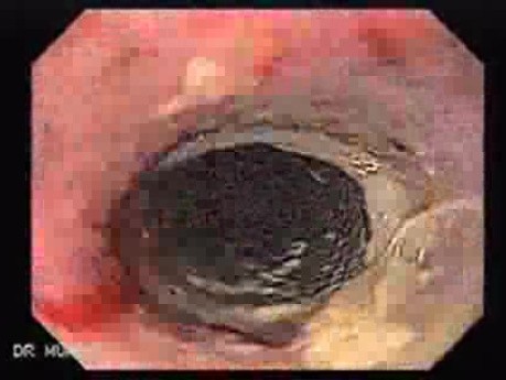 Placement Of The Esophageal Stent - 11/12