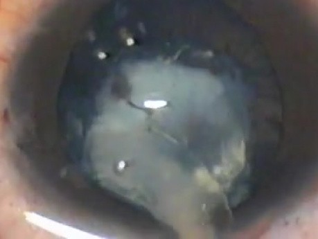 Sommering Ring Cataract - Fugo Plasma Capsulotomy
