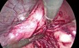 Retroperitoneal Fibroid