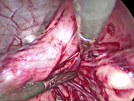 Retroperitoneal Fibroid