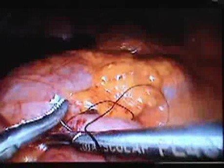 Jejunal Gastrointestinal Stromal tumor (GIST) (33 of 86)