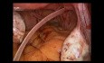 SELS - Laparoscopic Trans-Abdominal Cerclage (LTAC)