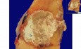 Gout - Histopathology - Interphalangeal joint of toe