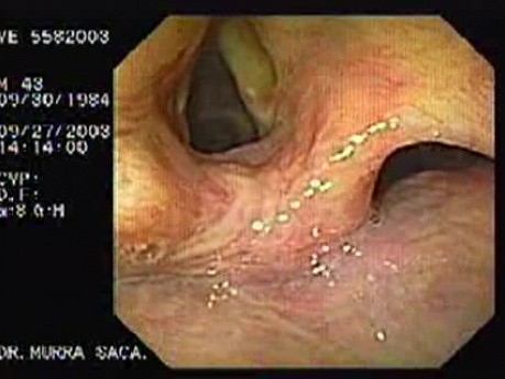 Acute Variceal Bleeding - Yellowish of the Laryngeal Mucosa