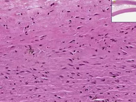 Atherosclerosis with fatty streak - Histopathology - Aorta