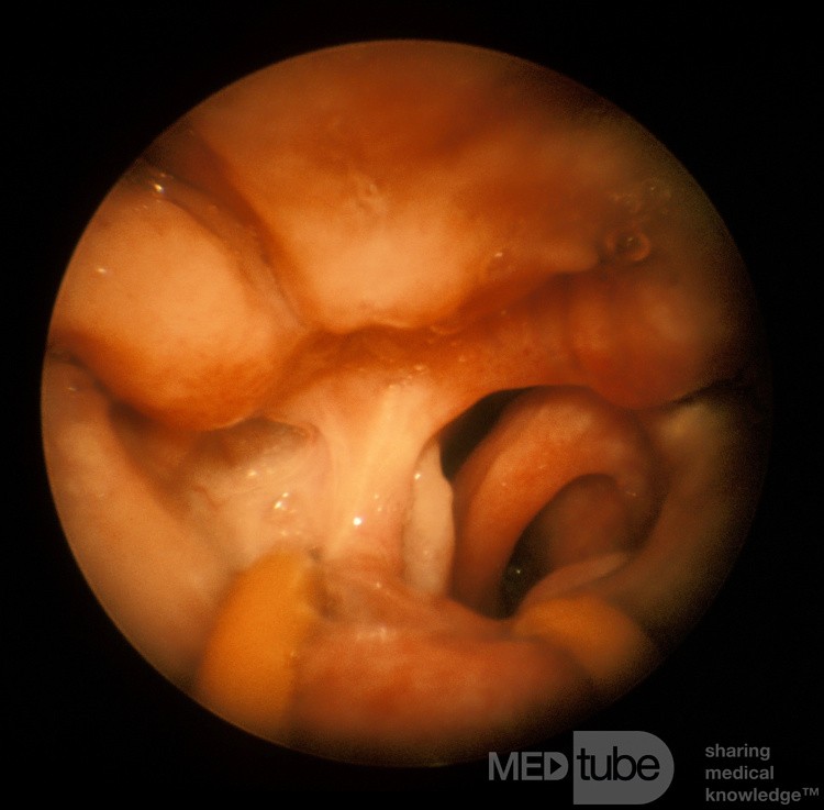 Unilateral Choanal Atresia