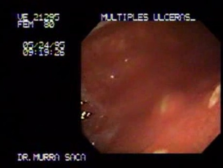 Multiple Gastric Ulcers