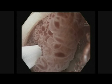 Underwater Endoscopic Mucosal Resection (UEMR)