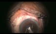Complex Cataract Surgery with Missing Zonule Surprise