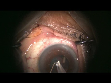 Complex Cataract Surgery with Missing Zonule Surprise