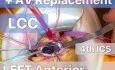 TCRAT-CABG + AVR via Left Anterior Thoracotomy