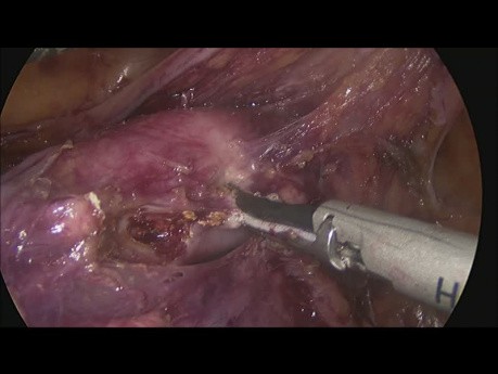 Total Laparoscopic Hysterectomy + Lymphadenectomy Done Completely