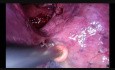 Double Sleeve Uniportal Video-Assisted Thoracoscopic Lobectomy